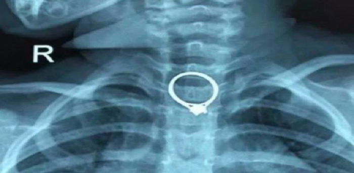 Anak tertelan cincin ibu tanpa sengaja, jauhkan objek kecil yang berbahaya dari anak anda!