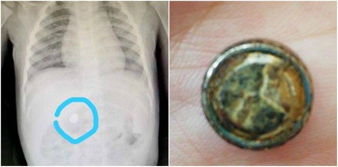 Awas dengan skru longgar dan bateri kecil kalau tidak mahu bayi tertelan bateri berbahaya!