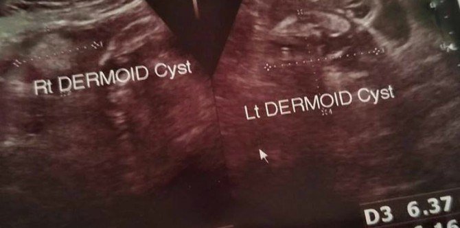 Pentingnya checkup tahunan: Wanita ini kongsi pengalaman cyst dalam ovarinya!