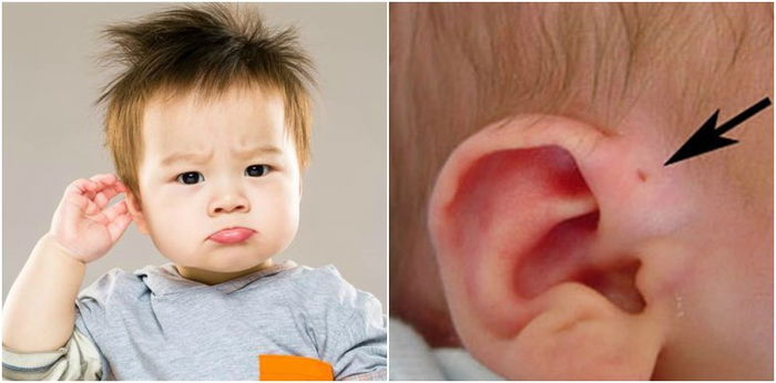 Ada lubang kecil di telinga bayi saya, adakah ia perlu dirawat?