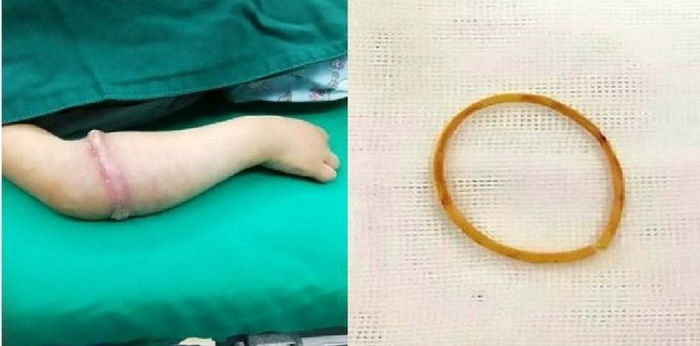 Akibat pakai gelang getah terlalu lama, tangan kanak-kanak ini harus dibedah