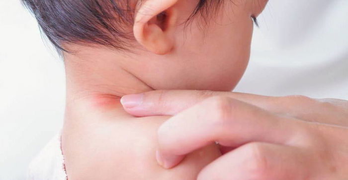 Rash or eczema? Here’s how to find out