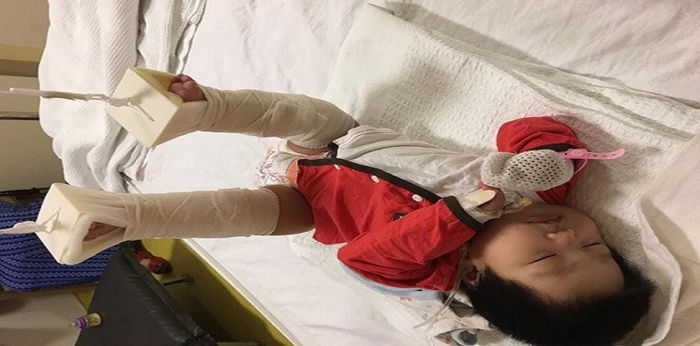 Bayi Patah Tulang Paha Lepas Balik Taska - Anda Tahu Apa Tanda Anak Didera?