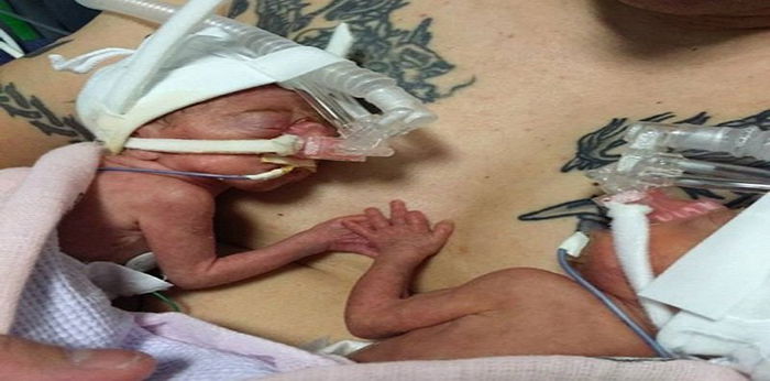 Inilah bayi kembar pramatang terkecil dengan berat badan kurang 1 kg!