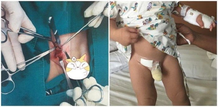 Hernia Pada Bayi, Waspada Tanda-Tanda Ini Sebelum Bayi Perlu Dibedah