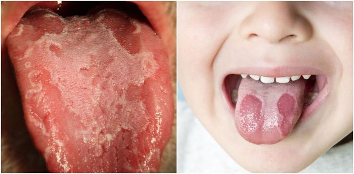 Lidah bayi ada corak begini, adakah ia membahayakan kesihatan mereka?