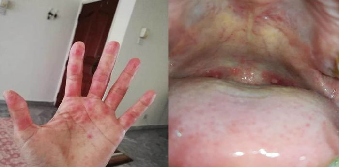 Tidak Hanya Bayi & Kanak-Kanak, Virus HFMD Juga Boleh Dijangkiti Orang Dewasa!