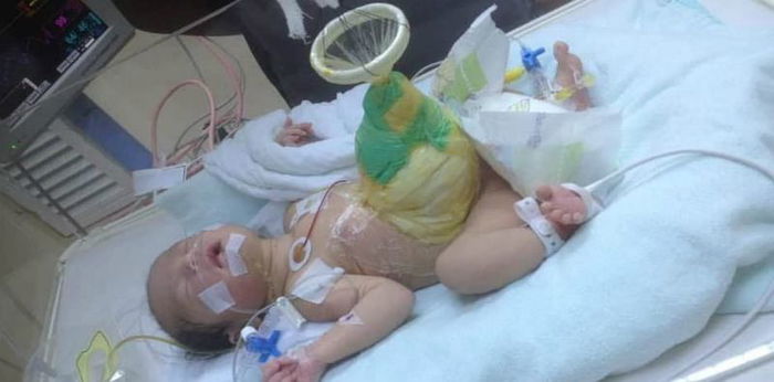 Pilu hati! Bayi yang derita usus di luar selepas lahir ini perlukan bantuan