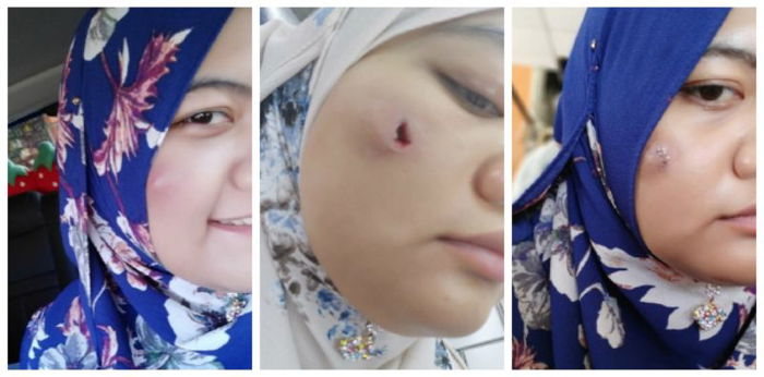 Akibat salam berlaga pipi, muka gadis ini terpaksa dibedah kerana jangkitan!