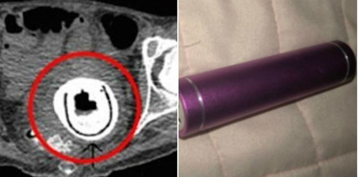 Doktor jumpa sex toy tersekat dalam wanita ini selama 10 TAHUN tanpa dia tahu!