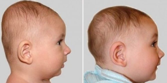 Kepala Bayi Baru Lahir Rata, Tidak Bulat Dan Berbentuk Pelik? Ini Sebabnya