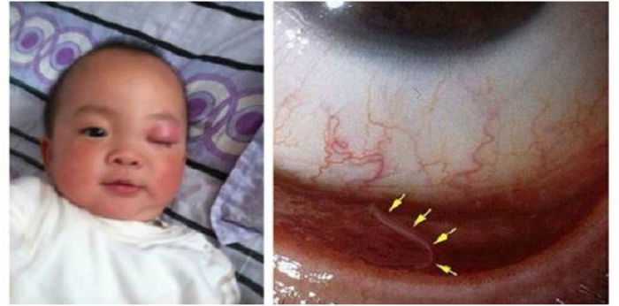 Akibat tabiat tak suka basuh tangan, cacing BERENANG dalam mata bayi ini!