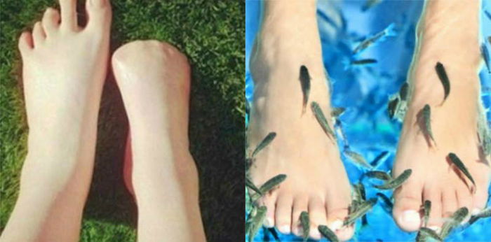 BAHAYA Spa Ikan, Wanita Ini Hilang Semua Jari Kakinya Akibat Jangkitan Teruk!