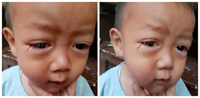 Kanak-Kanak Ini Menangis Keluar Air Mata Darah, Dipercayai Punca Radiasi Gajet