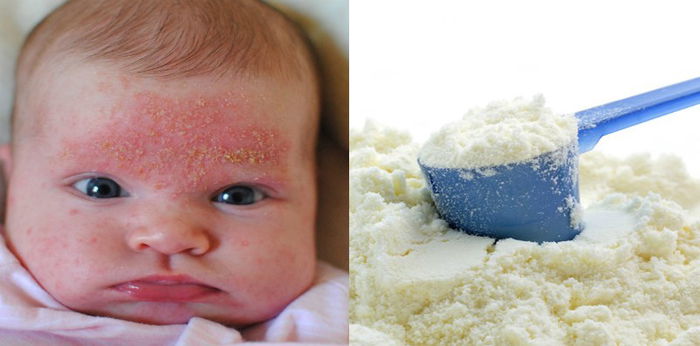 Senarai Susu Untuk Anak Ekzema, No #3 Paling Sesuai, Boleh Guna Cegah Alahan Anak