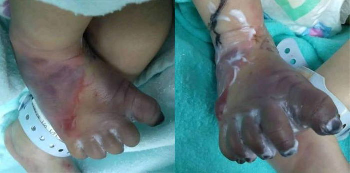 Lepas ambil darah di hospital Sibu, kaki bayi baru lahir ini bengkak dan biru!