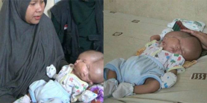 Bayi Ini Lahir Dengan Dua Wajah Namun Satu Kepala, Apa Yang Terjadi?