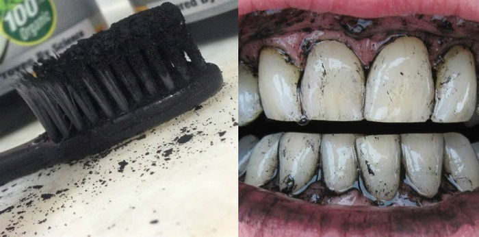 Serbuk Arang Putihkan Gigi Atau Buat Gigi Terhakis & Bengkak? Ini Kata Doktor