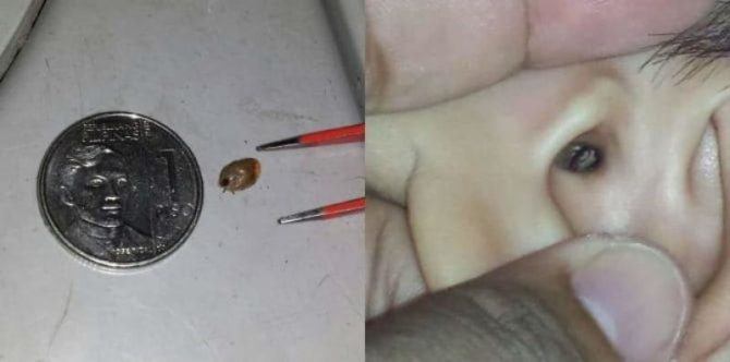 Kanak-Kanak Ini Hampir Pekak Kerana Kutu Rambut Masuk Ke Telinganya!