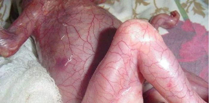 Bayi Lahir Tanpa Kulit Kerana Ibu Makan "Ubat" Bahaya Ketika Hamil?