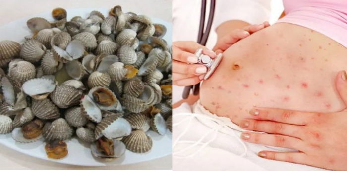 Bahaya Ambil Makanan Mentah Ketika Hamil, Wanita Maut Lepas Makan Kerang