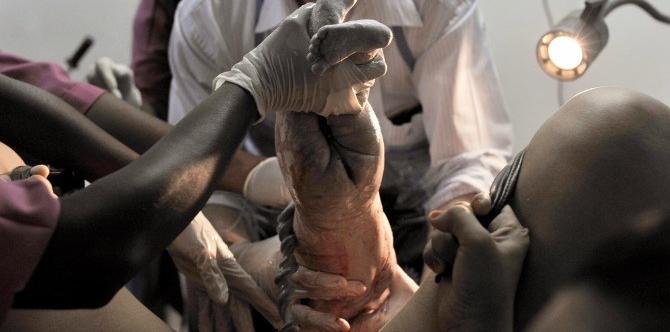 Breech baby decapitated highlights dangers of forgoing a C-section