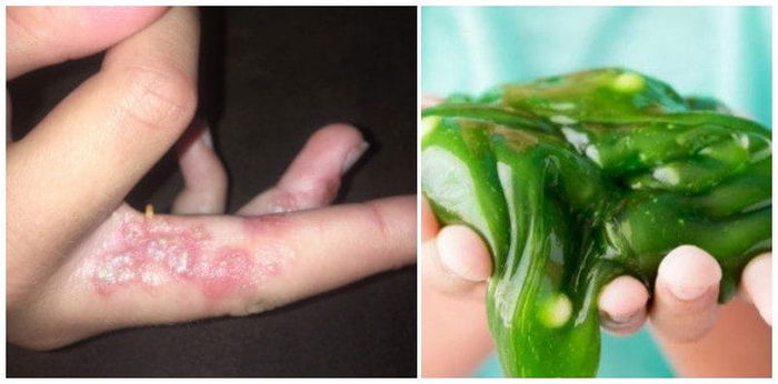 Mum finds daughter's fingers covered in blisters after playing with slime