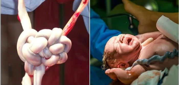 4 Tanda Bayi Terbelit Tali Pusat Sekitar Leher Ketika Dalam Kandungan Anda