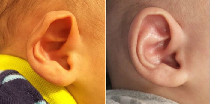 6 Bentuk Telinga Bayi Yang Menggambarkan Personalitinya, Tak Sangka Setepat Ini!
