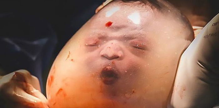 Ajaib, Bayi Ini Lahir Dengan Ketuban Belum Pecah - Sampai Boleh Nampak Mimik Muka!