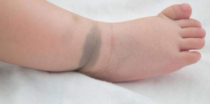 Mongolian spots in babies: Need-to-know information