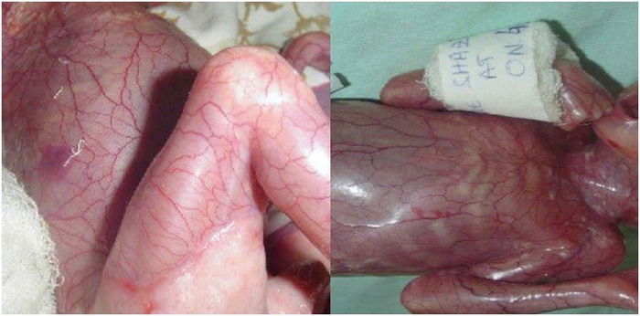 Was this baby born skinless because his mum took potent drugs in pregnancy?