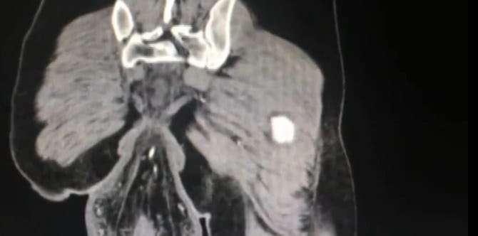 Man's bowels fall out after sitting on toilet for too long