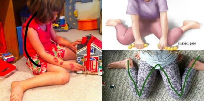 If your child is sitting in the "W" position, stop him right now!