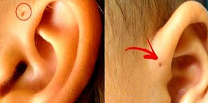 Does your child have a tiny hole near their ear? Here's what it is
