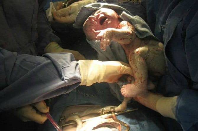 C-Section Birth Images That Help Normalise Birth