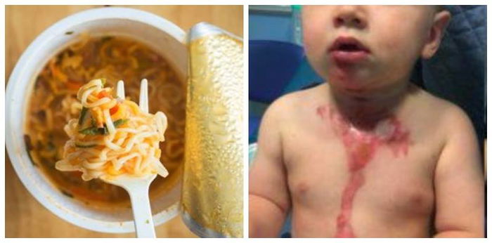 Instant noodles send thousands of kids to the ER