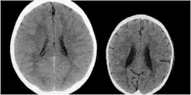 Effect of abuse on a child's brain: These images will shock you!