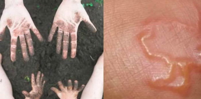 Akibat Suka Main Pasir, Tangan Kanak-Kanak 6 Tahun Ini Terkena Jangkitan Cacing Tanah!