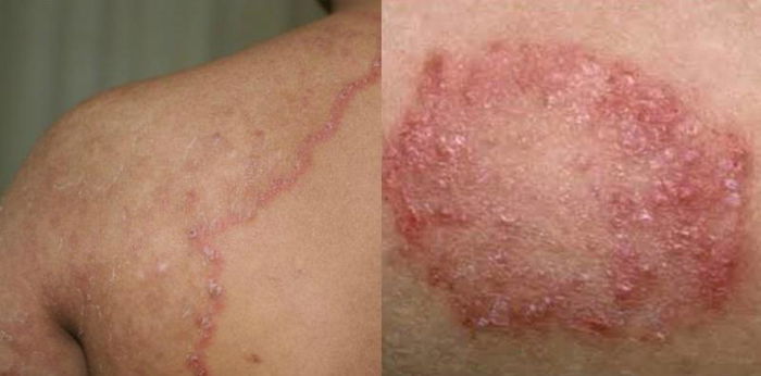 Kurap Kering: Ini Cara Efektif Untuk Hilangkan Kegatalan & Parut