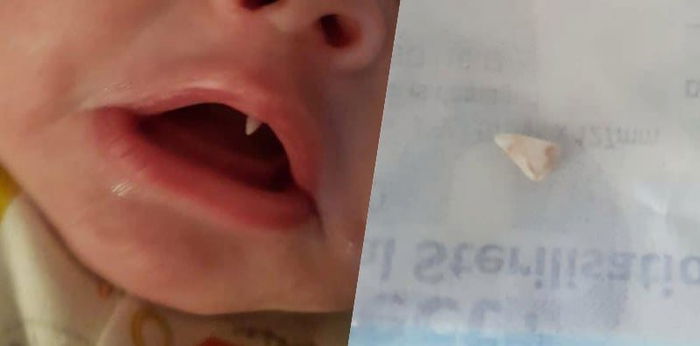 Mum freaks out when her 2-month-old grows a sharp tooth overnight