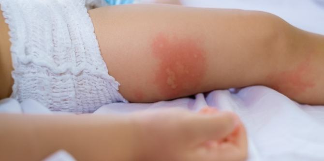 Toddler rashes: Watch out for these 15 common children's skin conditions