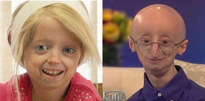 Kenali Progeria, Penyakit Yang Buat Kanak-Kanak Nampak Lebih Tua Dari Usia!