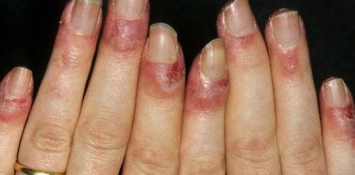 Akibat Kongsi Barang Manicure Dengan Sepupu, Gadis 22 Tahun Ini Terkena Jangkitan HIV!