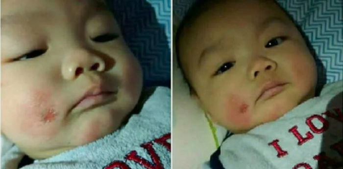 Gara-Gara Dipegang & Dicium Orang, Bayi Ini Derita Dermatitis Atopik Yang Sukar Dipulihkan!