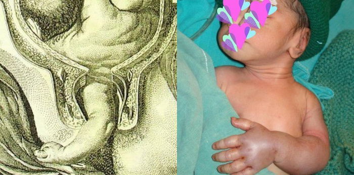 BAHAYA Bayi Melintang Dalam Rahim: Boleh Patah Anggota Badan Jika Tak Terus Czer!