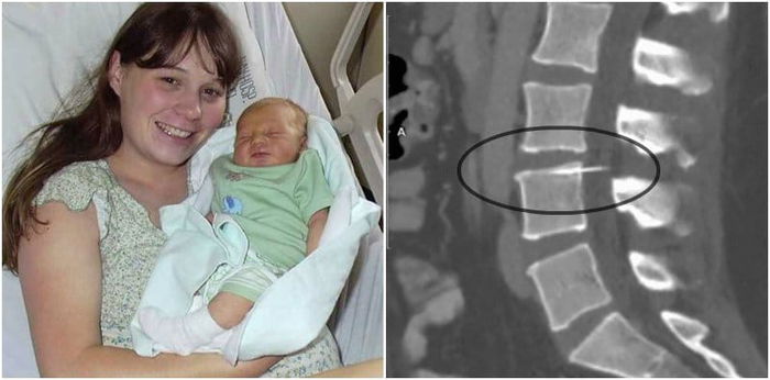 Broken epidural needle found in mum's spine 14 years later