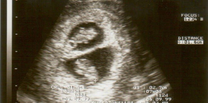 Woman becomes pregnant twice in 10 days because of a rare medical phenomenon