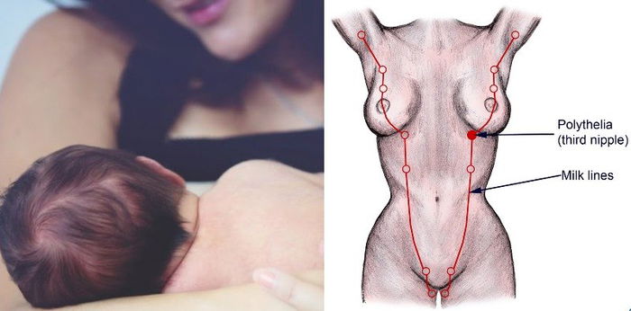 Wanita Keluar Susu Dari Vulva Akibat Tisu Ektopik, Ini Kes Sangat Jarang Berlaku!