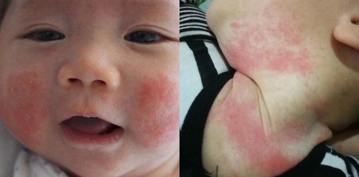 25 Petua Hilangkan Ruam Bayi Dengan Selamat, Tak Perlu Guna Ubat Yang Ada Steroid!
